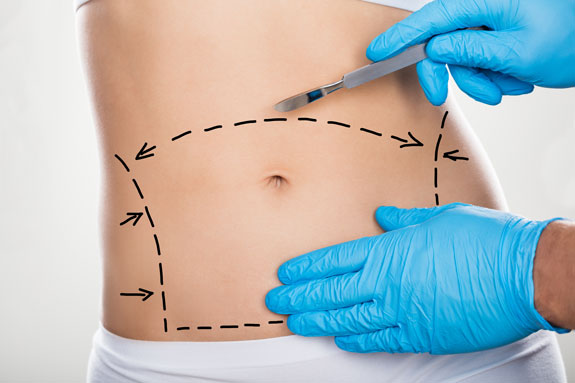 Abdominoplastik Ulm